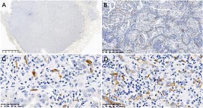 CD34 evaluation of microvasculature in lung adenocarcinoma and its microvascular density predicts postoperative tumor recurrence